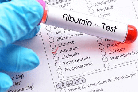 Xét nghiệm Albumin là một xét nghiệm quan trọng để phát hiện bệnh