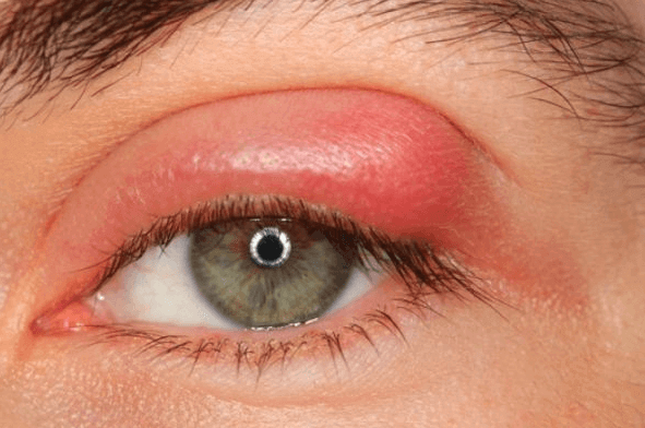 Mí mắt sưng là dấu hiệu cần thực hiện xét nghiệm Albumin