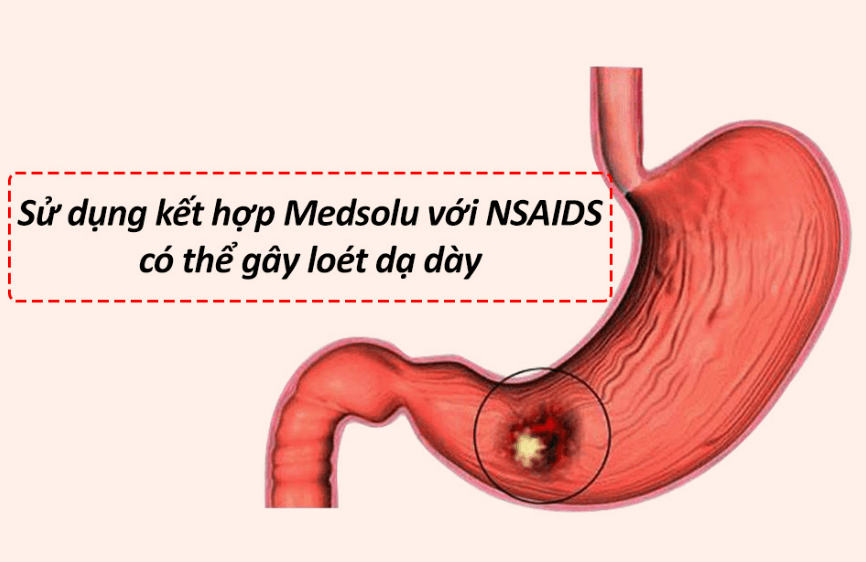 Sử dụng Medsolu với NSAIDS có thể gây loét dạ dày