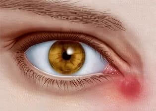 Sử dụng thuốc nhỏ mắt Oflovid để điều trị viêm túi lệ